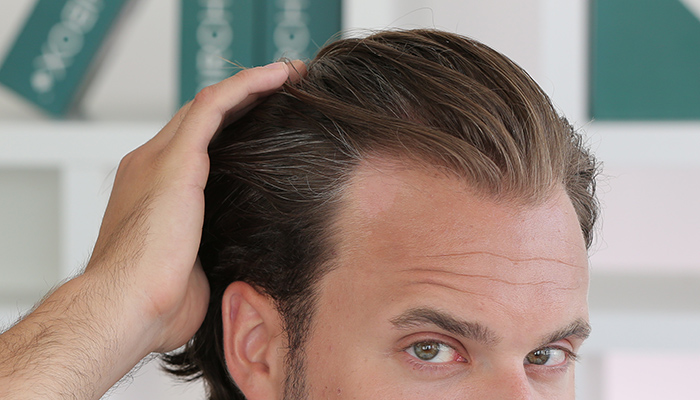 how to get hair to regrow